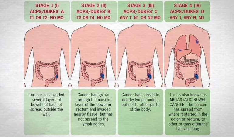 Bowel cancer stages and size